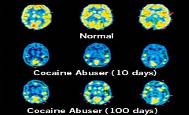 Brain on cocaine
